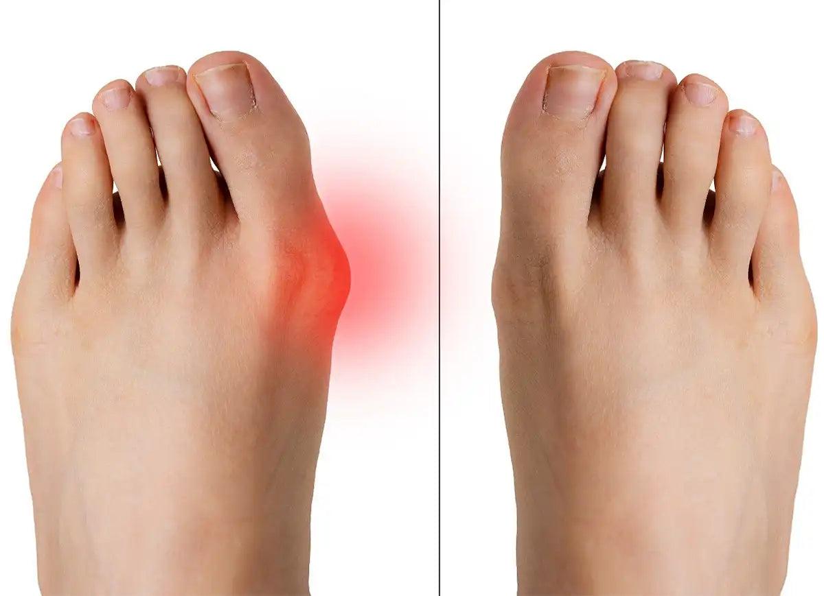 LES DOULEURS DE L'HALLUX VALGUS ET COMMENT LES SOULAGER